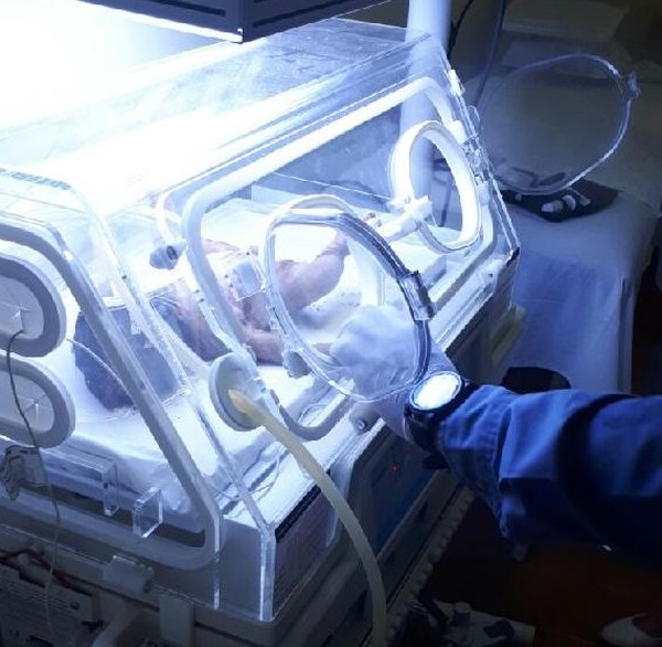 Índia recém-nascida enterrada viva em MT deve fazer cirurgia para retirada de cateter